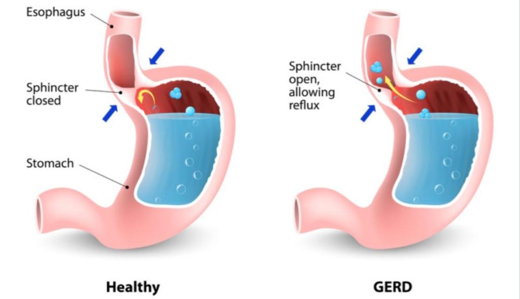 GERD ICD 10 Codes Coding guidelines with examples